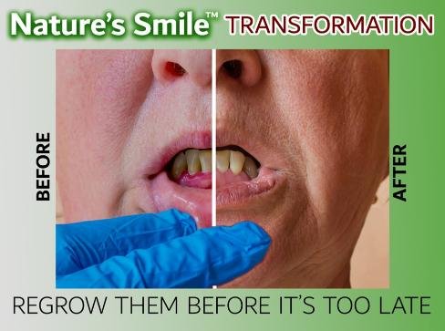 Nature Smile Before and After Results